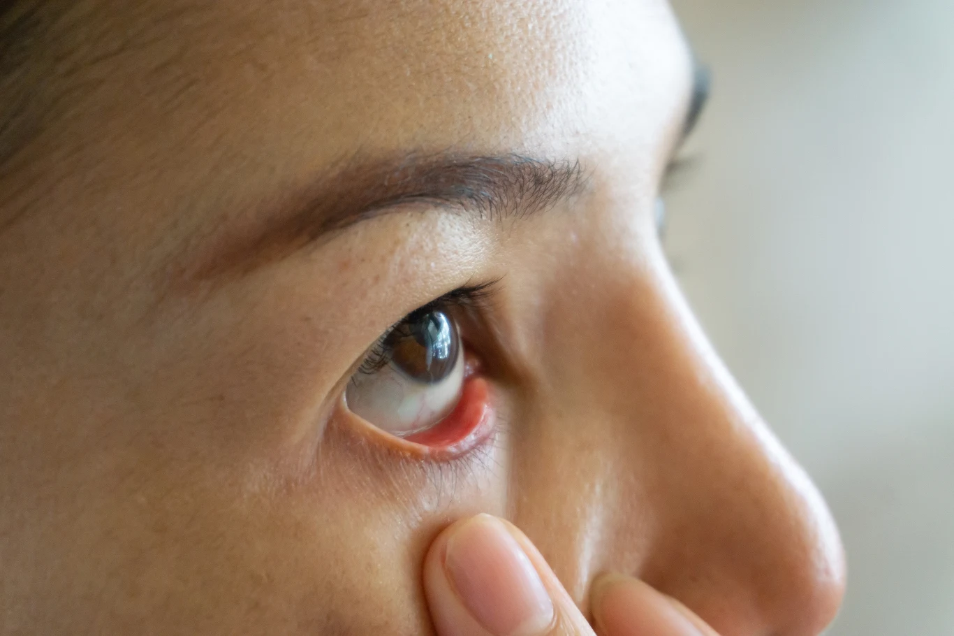 Objawy boreliozy mogą dotyczyć także oczu