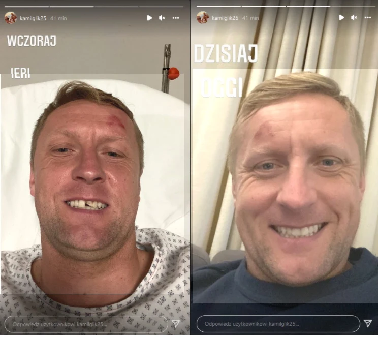 Kamil Glik już naprawił uszkodzonego zęba
