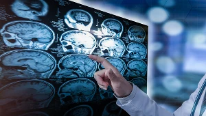 Kondycja serca i układu krwionośnego bezpośrednio wpływa na ryzyko zachorowania na alzheimera