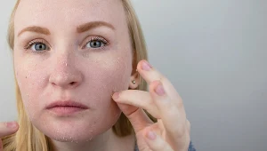 W okresie wiosennym skóra staje się przesuszona, swędząca i m a tendencję do łuszczenia się 