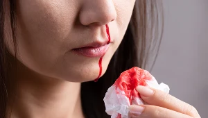 Krwawienia z nosa oraz z dziąseł to częste objawy, jakie pojawiają się przy plamicy małopłytkowej