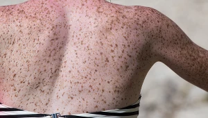 Zmiany na skórze po kontakcie ze słońcem. Zwykłe piegi czy coś gorszego?