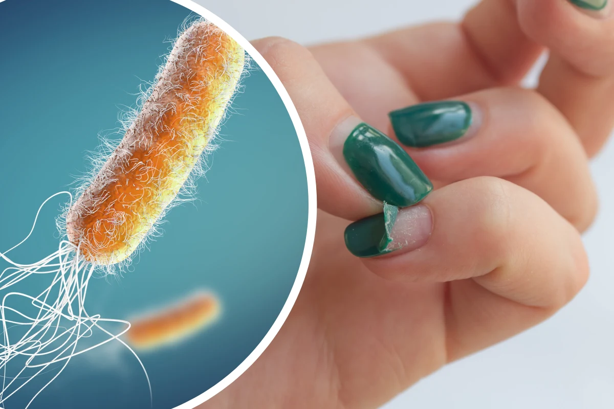 Na paznokciach infekcja pałeczką ropy błękitnej będzie widoczna w postaci zielonego nalotu na płytce, często ukryta pod lakierem hybrydowym 