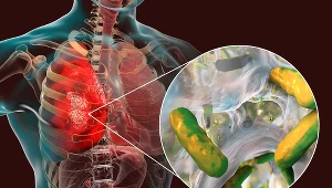 Pałeczka ropy błękitnej może wywołać sepsę, zapalenie płuc i mózgu. Złapiesz w ogrodzie lub szpitalu 