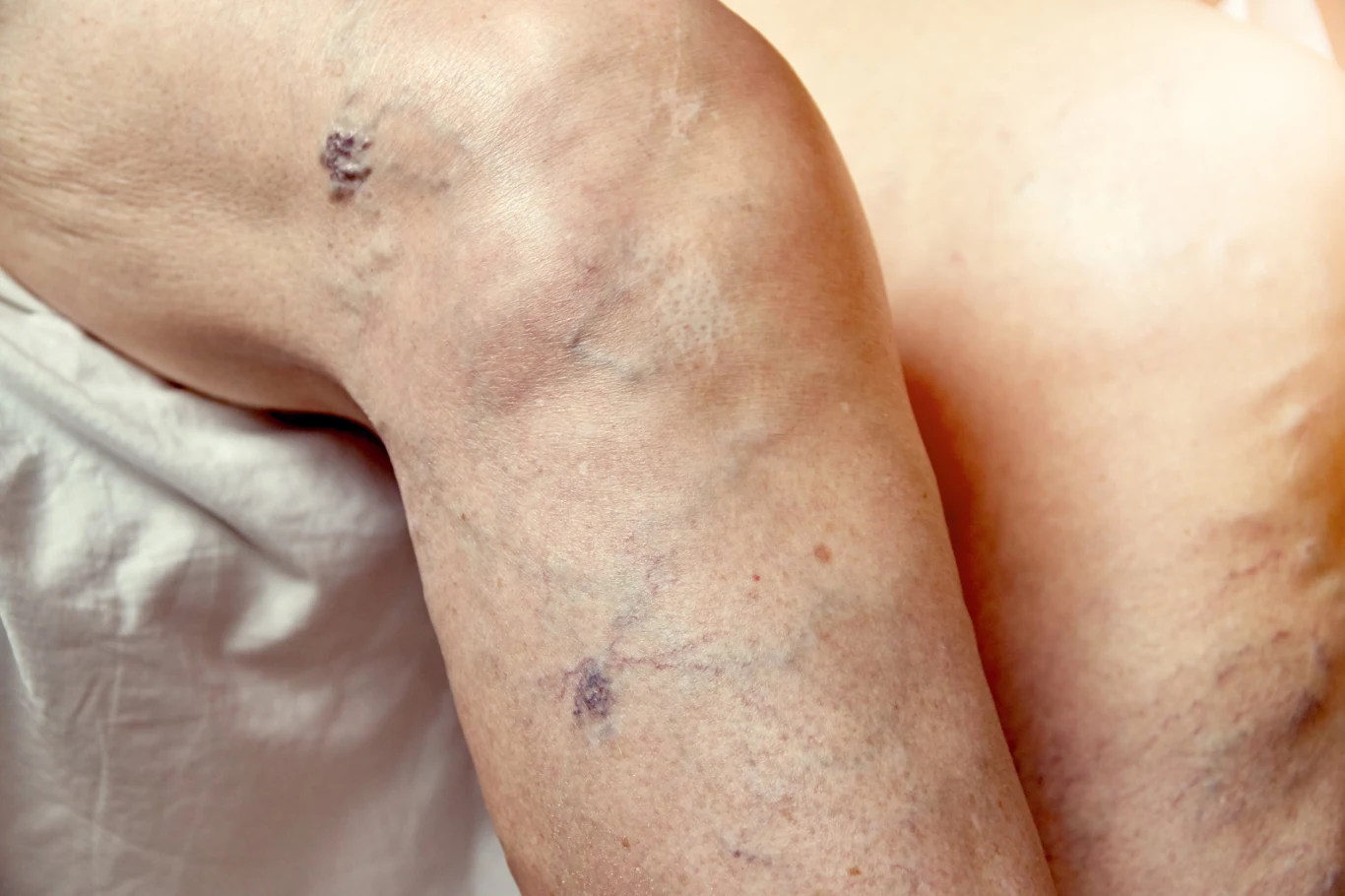 Choroby wywołujące przewlekły stan zapalny w organizmie również sprzyjają rozwojowi zaburzeń krzepnięcia krwi