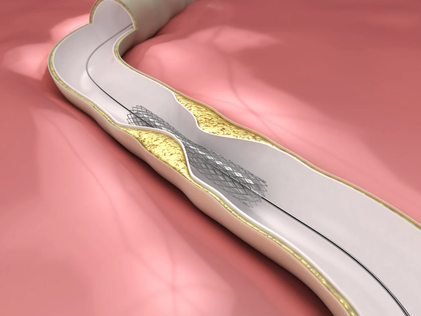 Wprowadzenie stentu w tętnicę wieńcową ma za zadanie rozszerzyć ją i zapobiec ponownemu zwężeniu 