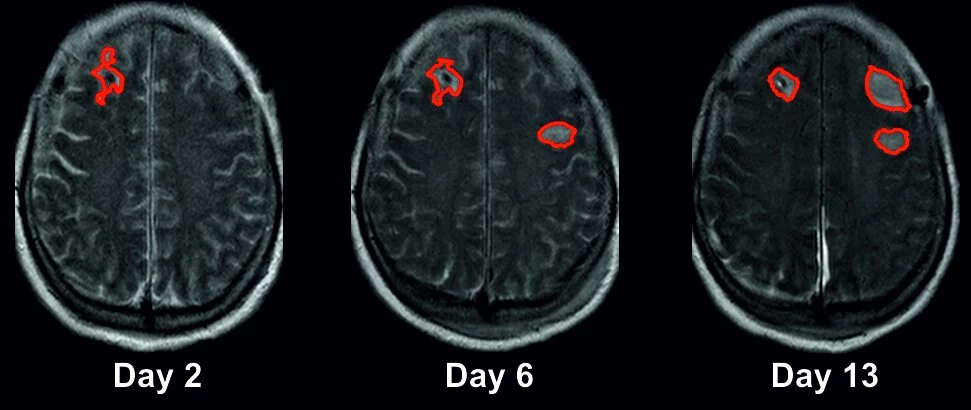 Obrazy MRI mózgu pacjentki wykonane w 2, 6 i 13 dniu po krwotoku podpajęczynówkowym. Obszary zaznaczone na czerwono pokazują rozwój nowych udarów niedokrwiennych w ciągu pierwszych dwóch tygodni od pierwszego krwotoku u pacjentki