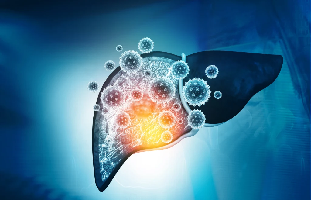 Zapalenie wątroby może przekształcić się w przewlekłą infekcję, prowadząc do marskości lub niewydolności wątroby Zapalenie wątroby może przekształcić się w przewlekłą infekcję, prowadząc do marskości lub niewydolności wątroby