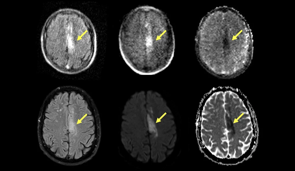Przenośny rezonans magnetyczny (górny rząd) może wykryć i scharakteryzować udar niedokrwienny mózgu rozpoznany za pomocą standardowego rezonansu magnetycznego (dolny rząd) - odkryli naukowcy z Yale