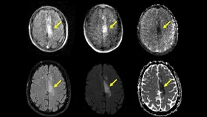 Udar mózgu udarowi nierówny. Jest pomysł jak je odróżniać