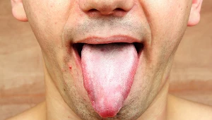 Biały nalot na języku może świadczyć o odwodnieniu, grzybicy lub innej infekcji organizmu