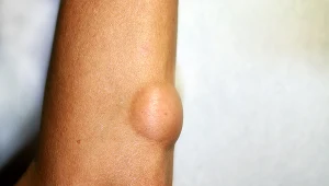 Tłuszczaki to miękkie guzy o charakterze nowotworowym, zlokalizowane najczęściej na plecach, ramionach i karku