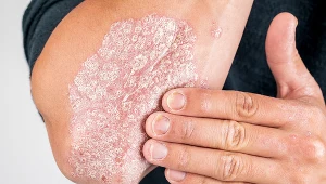 To nie tylko choroba skóry. Może zajmować stawy, serce czy oczy