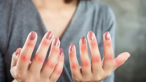 Ból, sztywność i obrzęk to były pierwsze objawy Marii