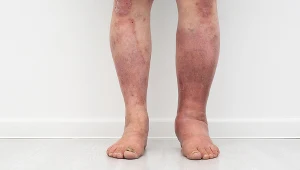 Zapalenie tkanki łącznej charakteryzuje się obrzękiem, bólem, tkliwością oraz uciepleniem zmienionego chorobowo miejsca