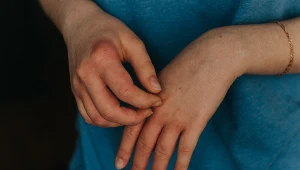 Świerzbowce lubią lokalizować się w fałdach skórnych, okolicach pach, pachwin i palców u rąk