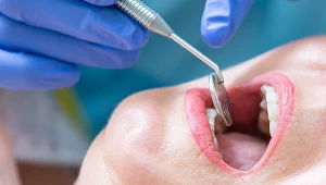 Zmiany dotyczące jamy ustnej są w cukrzycy dość charakterystyczne