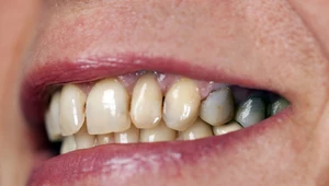 Domowy sposób na białe zęby. Trik z węglem zdziała cuda