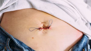 Jelito lub pęcherz może zmienić położenie. Tak objawia się przepuklina