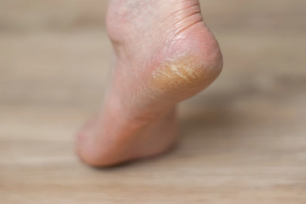 Jak w domowych warunkach zadbać o popękane stopy?