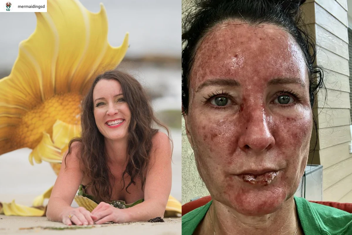 Wieloletnie opalanie bez zabezpieczeń w postaci kremów z filtrem, wywołało raka skóry u znanej animatorki dziecięcej