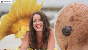 Niewielki guzek lub mały pieprzyk. Pod tym może kryć się groźny nowotwór