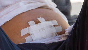 Paracenteza to odbarczenie jamy otrzewnej w przypadku, kiedy w jamie brzusznej nagromadziła się zbyt duża ilość płynu