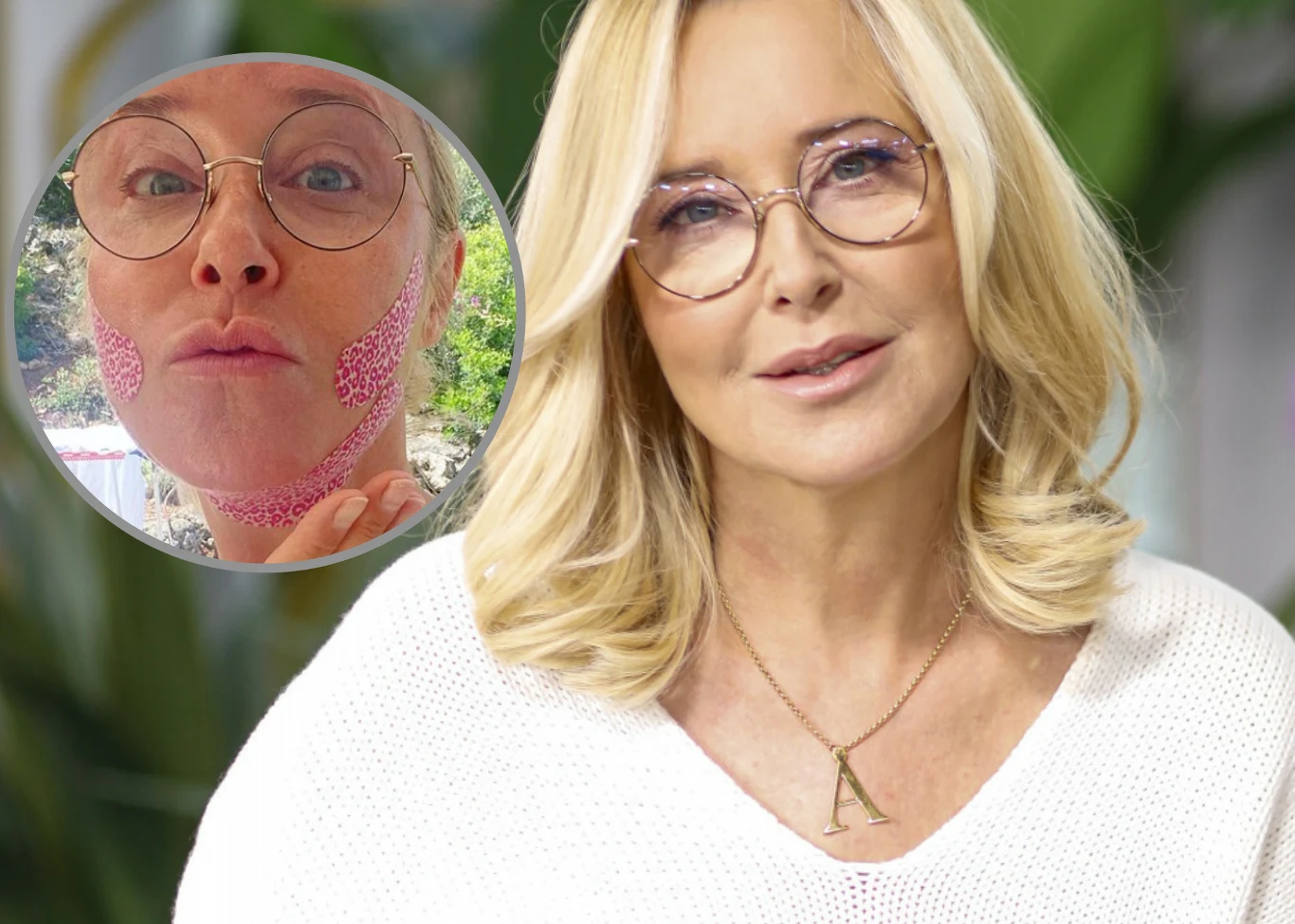 Agata Młynarska z siniakami na twarzy Agata Młynarska z siniakami na twarzy