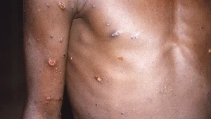 Większość ludzi wraca do zdrowia po małpiej ospie w ciągu kilku tygodni bez leczenia – powiedział cytowany przez „Nature” Jay Hooper, wirusolog z US Army Medical Research Institute of Infectious Diseases