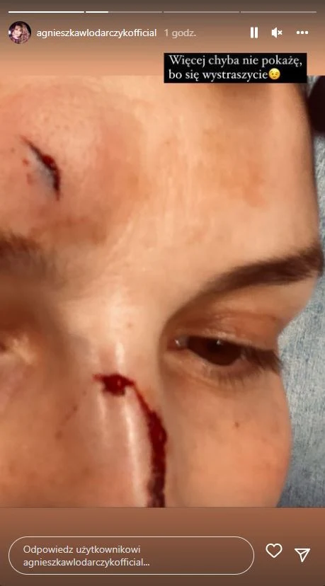 Pokazała fanom zdjęcia z obrażeniami i opatrunkiem