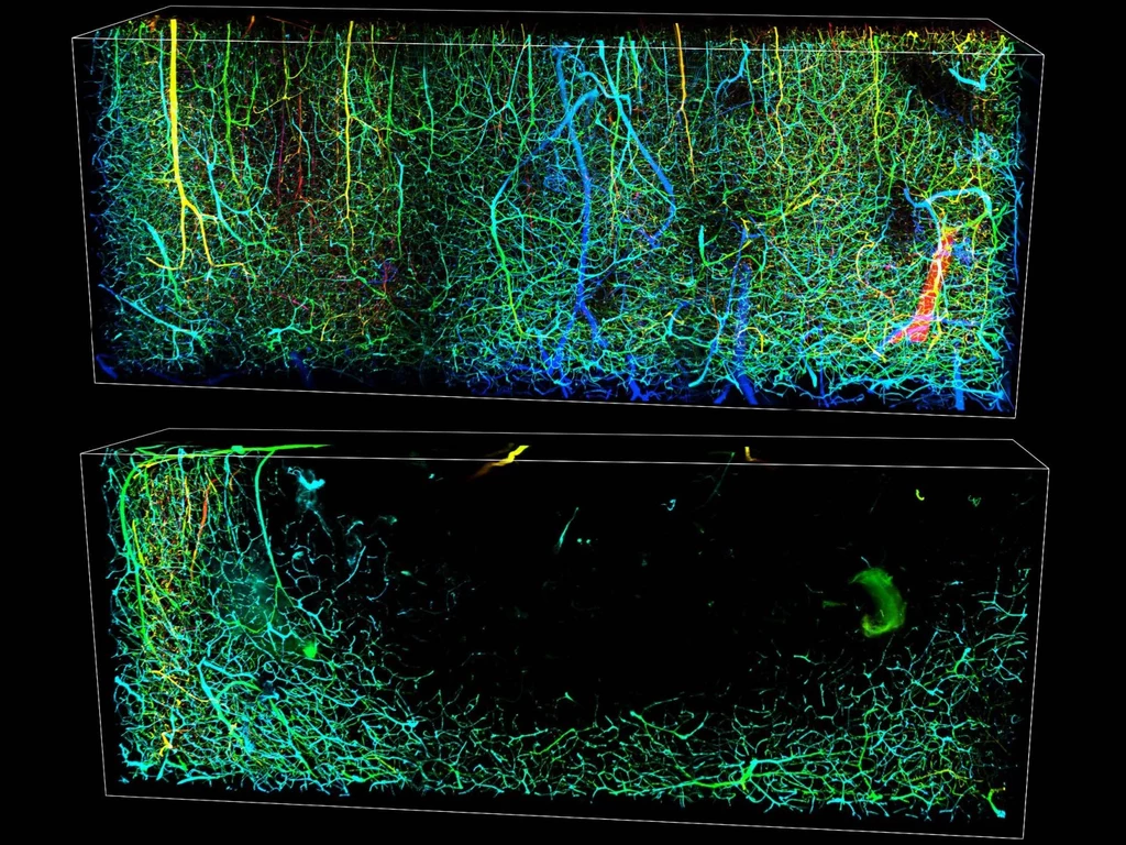 Obrazy 3D naczyń krwionośnych mózgu myszy przedstawiają stan normalny (góra) i po udarze niedokrwiennym (dół), który występuje, gdy zakrzep w naczyniu krwionośnym blokuje przepływ krwi w mózgu