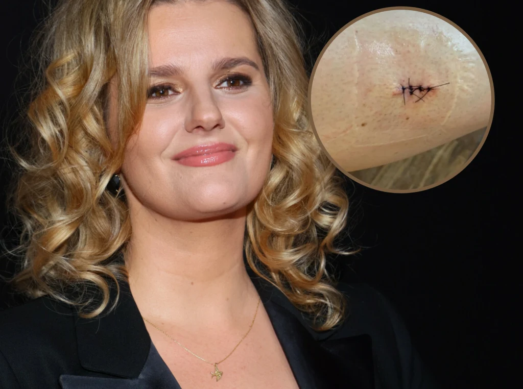 Zofia Zborowska miała czerniaka Zofia Zborowska miała czerniaka