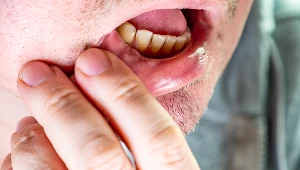 Pieczenie w jamie ustnej może utrzymywać się miesiącami. Co może być przyczyną?