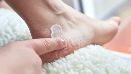 Popękane pięty mogą świadczyć o niedoborze cennych witamin