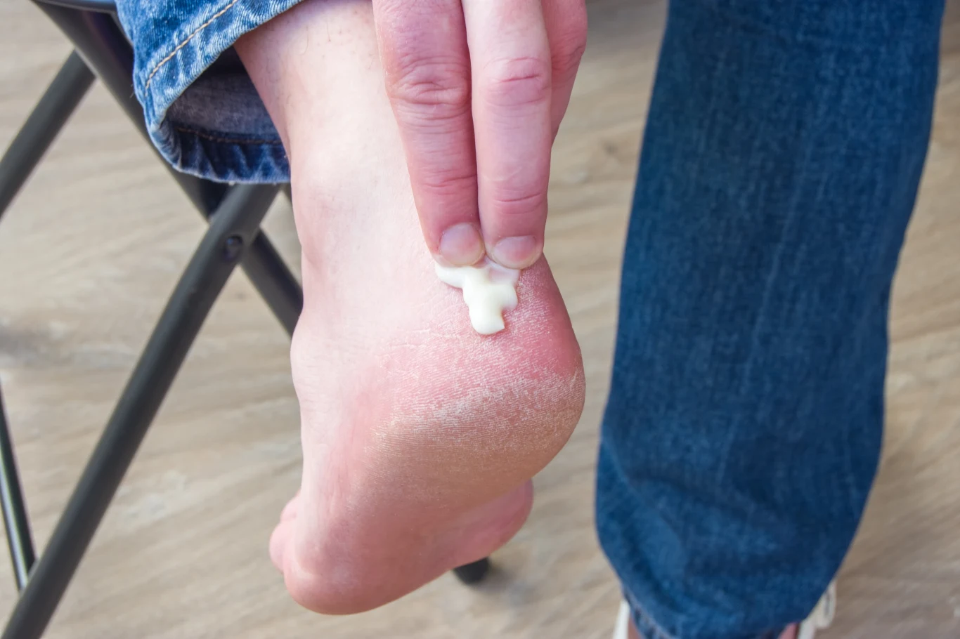 Suche pięty nie tylko wyglądają nieestetycznie, ale mogą świadczyć o poważnych niedoborach w organizmie 