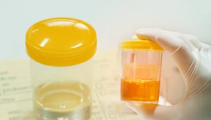 Zmiana zapachu moczu, tak jak i zmiana jego koloru, mogą świadczyć o poważnych problemach ze zdrowiem