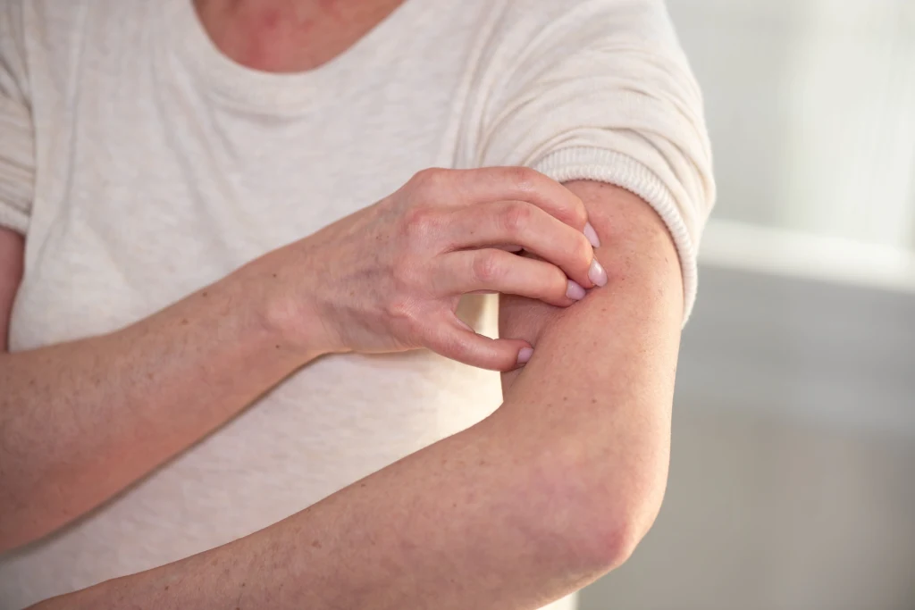 Kiedy wątroba szwankuje, pewne objawy możemy zaobserwować na skórze Kiedy wątroba szwankuje, pewne objawy możemy zaobserwować na skórze