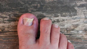 Letnie buty obnażają bolesny problem. Tak wyglądają paznokcie wielu z nas