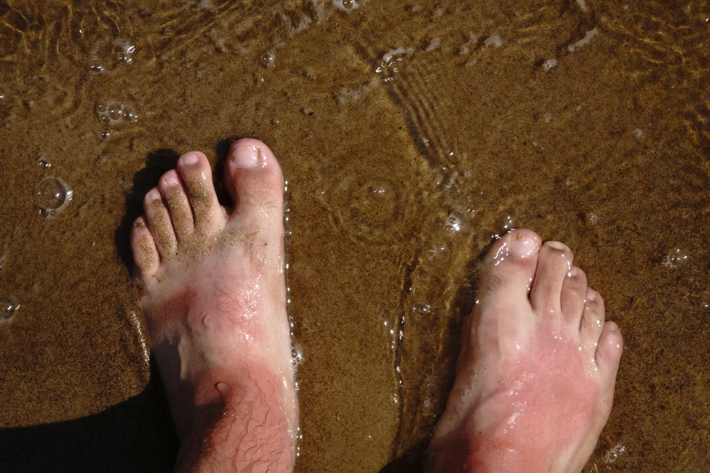 Grzybicy można nabawić się nie tylko pod zanieczyszczonym prysznicem, ale też podczas wędrówek po plażach