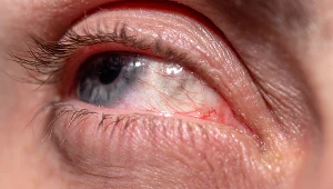 Czerniak oka to rzadki nowotwór złośliwy, ale spośród nowotworów narządu wzroku jest najczęściej diagnozowany