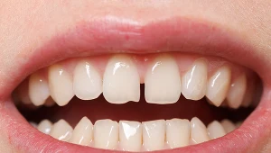 Diastemy można się pozbyć, ale nie każdy decyduje się na taki krok. Oto co trzeba wiedzieć