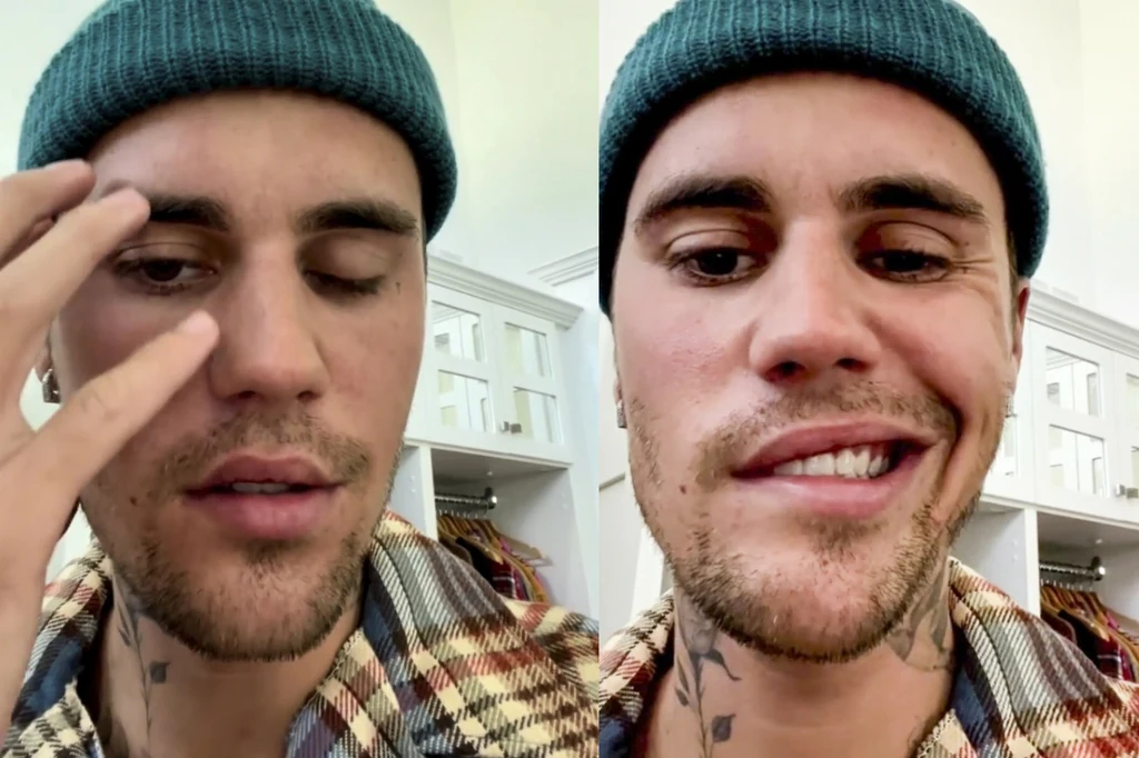 Justin Bieber cierpi na zespół Ramsaya Hunta. Wyjaśniamy, co to oznacza dla piosenkarza