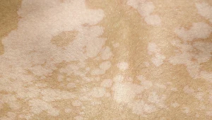 Łupież pstry najczęściej dotyka pleców, ramion, klatki piersiowej i szyi