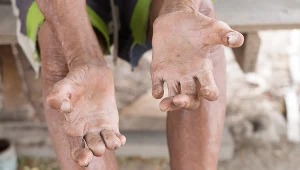 Trąd charakteryzuje się niewielkimi odbarwieniami skóry i uszkodzeniem nerwów obwodowych