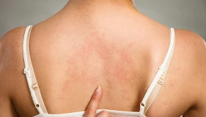 Niektórzy mylą ją z ospą lub półpaścem. By rozpoznać pokrzywkę należy przeanalizować szereg i innych objawów i okoliczności wystąpienia wysyoki