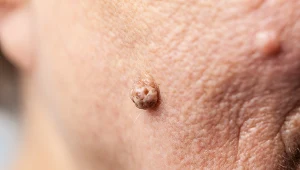 Włókniaki miękkie to wypukłe zmiany na skórze