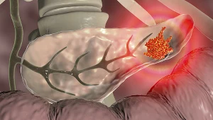 Rak trzustki. Daje późne objawy i małe szanse na przeżycie