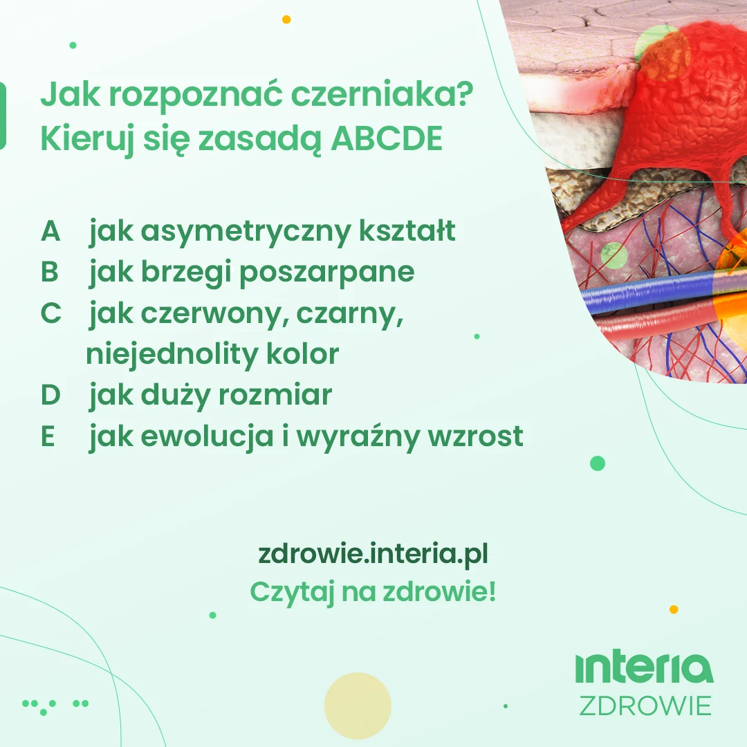 Jak rozpoznać czerniaka? Kieruj się zasadą ABCDE