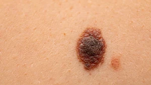 ABCADŁO czerniaka: A jak asymetria, B jak brzegi poszarpane, C jak czerwony, czarny, niejednolity kolor znamienia, D jak duży rozmiar i E jak ewolucja