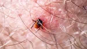 Im szybciej usuniemy kleszcza, tym lepiej. Co w sytuacji, gdy jego część została w skórze? Wyjaśniamy